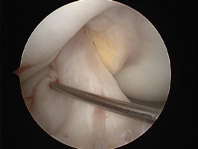 Figure 1b - Arthroscopic view into the right knee.  The metal probe sits across a normal-appearing ACL.