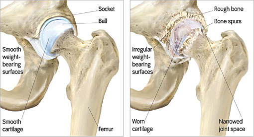 Bone-Sparing Total Hip Resurfacing Arthroplasty Surgery (Metal-on