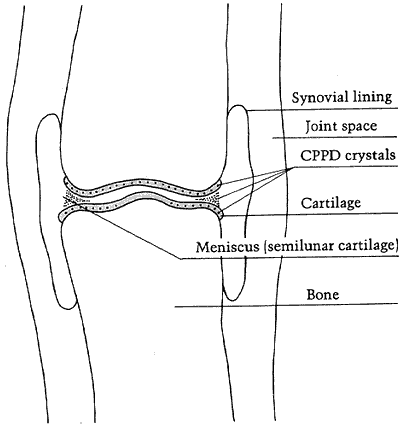 CPPD Deposition Disease | UW Orthopaedics and Sports Medicine, Seattle