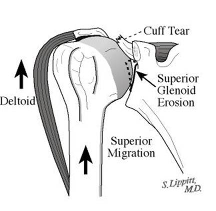 rotator cuff arthropathy