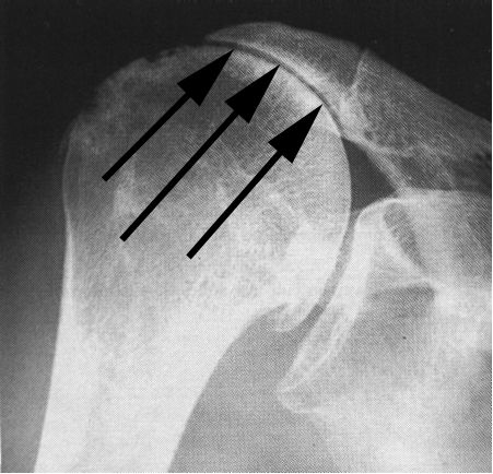 rotator cuff arthropathy