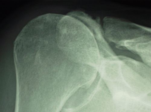 Rotator Cuff Arthropathy: Effective Treatment Options