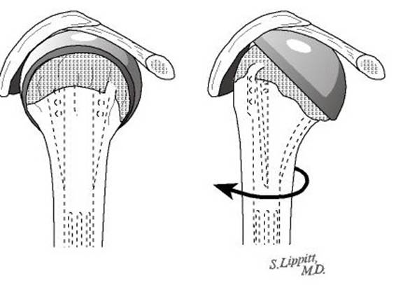 Rotator Cuff Tear Arthropathy St Albans