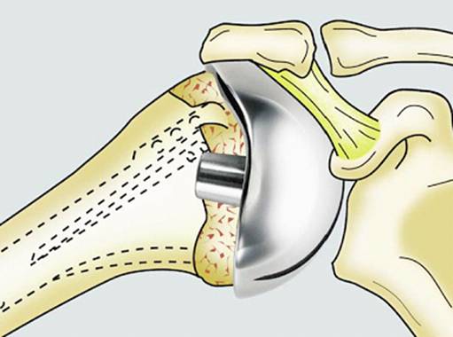 Home Exercises for the Unstable Shoulder  UW Orthopaedics and Sports  Medicine, Seattle