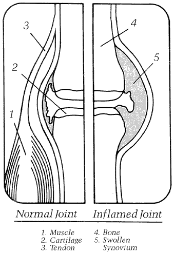 Figure 2 - Normal joint versus inflamed joint