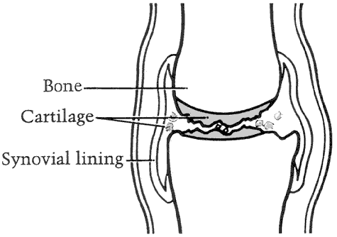 Figure 4 - Joint with severe osteoarthritis