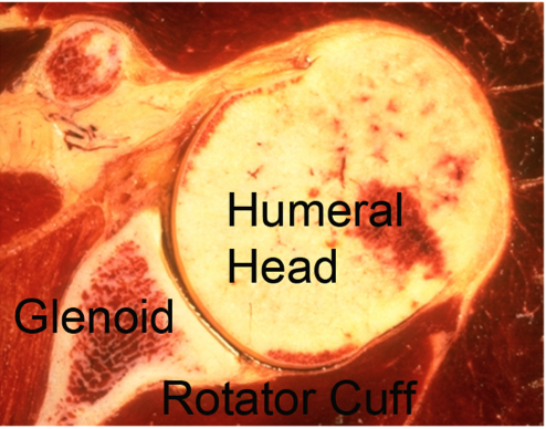 Rotator Cuff Tear: When to Repair and When to Smooth and Move the Shoulder