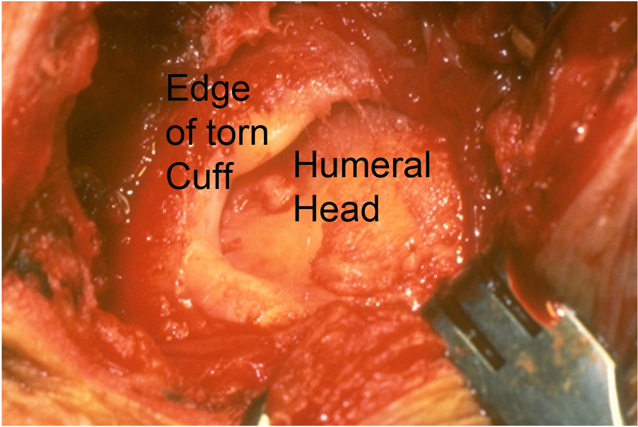 What Happens During a Rotator Cuff Repair?