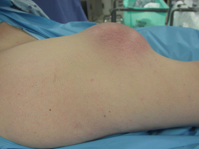 Firm lesion on the lateral thigh