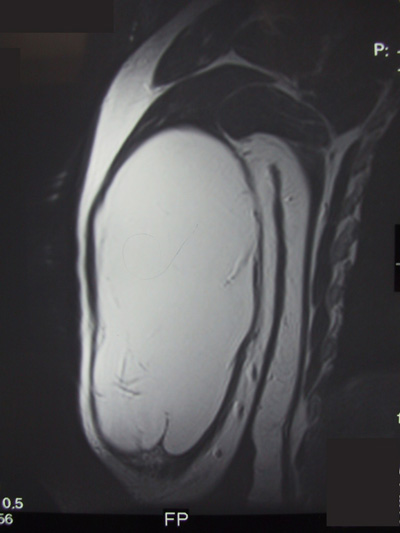 Lower Leg Mass with Uncharacterizable Malignancy