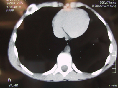 CT scan of the chest showing a large mass of the left lateral aspect of