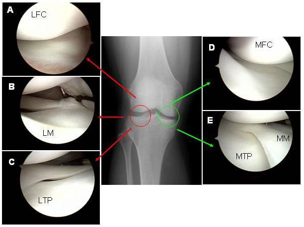 Micro Fractures For Athletes Uw Orthopaedics And Sports