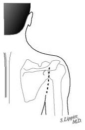 Figure 6 - A six-centimeter incision is based on the major posterior axillary crease