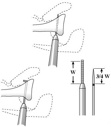 Figure 16 - The plane of the intended glenoid osteotomy is determined parallel to and one centimeter medial to the articular surface. A drill hole is made from anterior to posterior in the plane of the intended osteotomy. The depth of this hole is measured with a depth gauge  revealing the anteroposterior dimension of the glenoid in the plane of the intended osteotomy. A 3/4 inch flat and strong osteotome is marked with sterile tape at a length equal to 3/4 of the anteroposterior dimension of the glenoid.