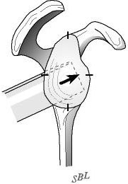 Figure 18 - The osteotome is inserted with a slight posterior inferior to anterior superior angulation