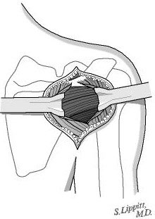 Figure 9 - The split is deepened to expose the posterior rotator cuff muscles