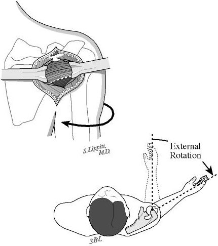 Figure 10 - The dissection of the posterior rotator cuff muscles is facilitated by externally rotating the arm