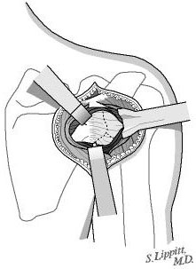 Figure 12 - The posterior glenohumeral capsule is exposed and inspected. Often a defect or very thin portion of the capsule can be identified