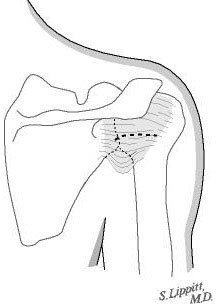 Figure 13 - A horizontal incision is made in the thinnest part of the capsule