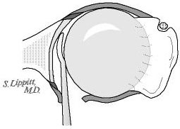 Figure 14 - Through the posterior capsular opening a blunt elevator is inserted into the joint to determine the plane of the glenoid
