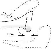Figure 15 - The plane of the intended glenoid osteotomy is determined parallel to and one centimeter medial to the articular surface