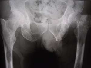 Metastatic cancer hip pain