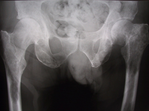 Bone cancer in the hip: Types, symptoms, and treatment