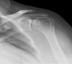 Figure 1	 Shows evidence of superior migration of the humeral head.