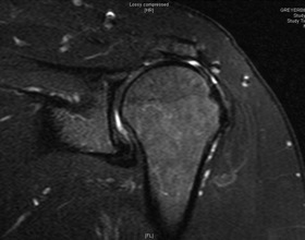 Figure 2	 Demonstrates a large defect in the supraspinatus tendon.