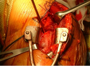 Figure 3	 Visualization of superior portion of latissimus dorsi tendon