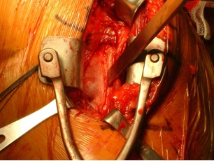 Figure 4	 Osteotome at the insertion of the latissimus dorsi/teres major tendons