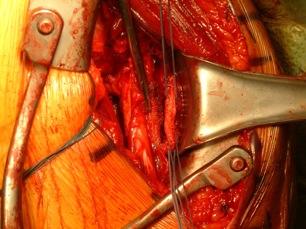 Figure 5	 Approximation of latissimus dorsi/teres major tendon with pectoralis major tendon stump