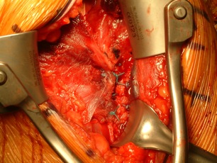 Figure 6	 Final fixation of pectoralis major tendon back to tendon stump and incorporation of transferred latissimus dorsi/teres major tendons