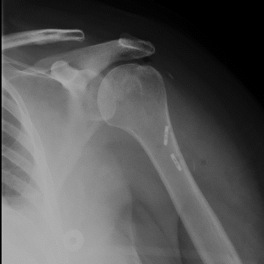 Figure 7	 Post-operative  view reveals improved glenoid/humeral head alignment