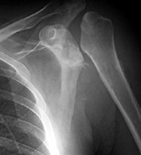 Figure 1 - Destruction of the humeral head with an associated soft tissue mass