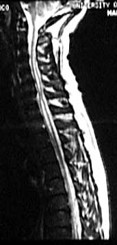 Figure 2 - Cervicothoracic syrinx