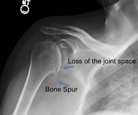 Osteoarthritis X Ray Shoulder