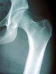 Hip Arthritis - Normal hip x-ray