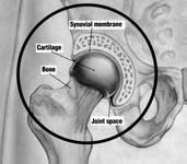 Hip Artritis - Normal hip cartilage