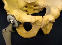 Hip Arthritis - Typical hip replacement components in their position relative to the hip and pelvis.