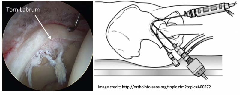 Hip Rehabilitation Exercises - OrthoInfo - AAOS