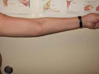 Fig. 6 - Elbow Arthritis/Elbow Arthroplasty. Postop Extension.