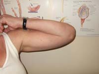 Fig. 5 - Elbow Arthritis/Elbow Arthroplasty. Postop Flexion