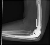 Elbow Arthritis/Elbow Arthroplasty. Postop X-ray Lateral