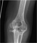 Elbow Arthritis. Preop X-Ray AP.