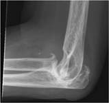 Elbow Arthritis. Preop X-ray Lateral