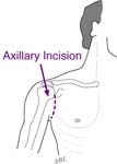 Bankart Lesion Fig 13 - Axillary incision leaves a small scar