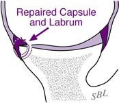 Bankart Lesion Fig 18 - Repaired Capsule and Labrum