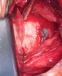Bankart Lesion Fig 6 - Shoulder dislocation - Failed arthroscopic Bankart repair