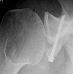 Bankart Lesion Fig 9 - Shoulder dislocation - bone block secured in place to replace glenoid bony defect